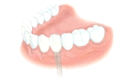 Teeth implantation permits to save the adjacent teeth from a process of their reduction under the bridges.